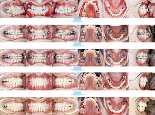 治療例（大人の矯正歯科治療）12