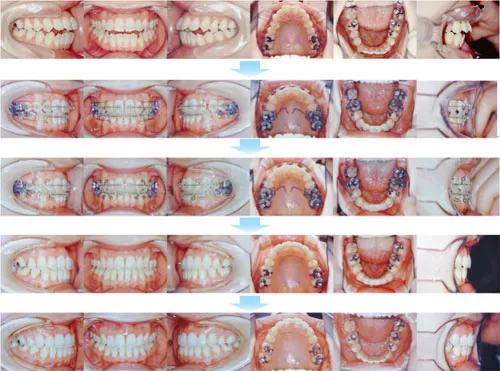 治療例（大人の矯正歯科治療）13