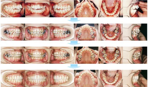 治療例（大人の矯正歯科治療）14