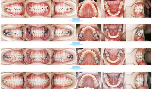 治療例（大人の矯正歯科治療）15