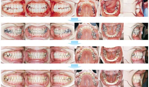 治療例（大人の矯正歯科治療）16