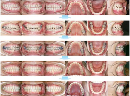 治療例（大人の矯正歯科治療）17