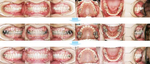 治療例（大人の矯正歯科治療）18