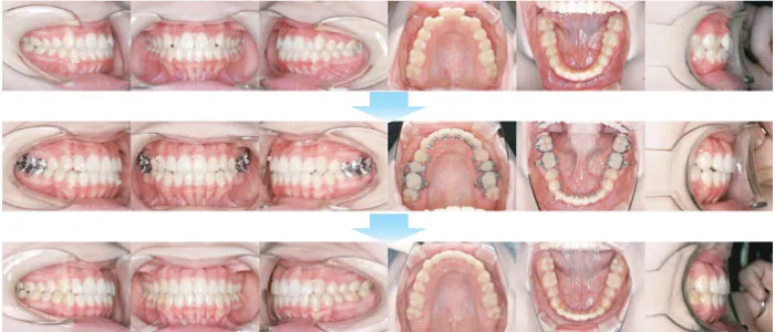 治療例（見えない矯正歯科治療（舌側矯正治療））01