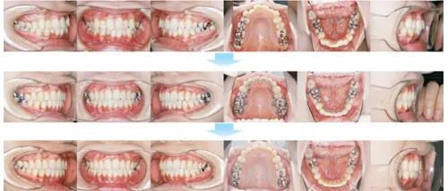 治療例（見えない矯正歯科治療（舌側矯正治療））02