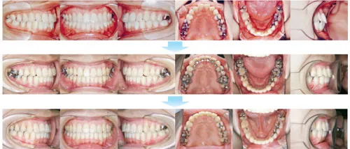 治療例（見えない矯正歯科治療（舌側矯正治療））03