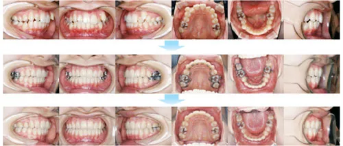 治療例（見えない矯正歯科治療（舌側矯正治療））04