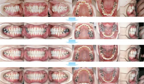 治療例（見えない矯正歯科治療（舌側矯正治療））05