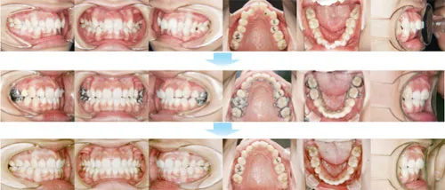 治療例（見えない矯正歯科治療（舌側矯正治療））06