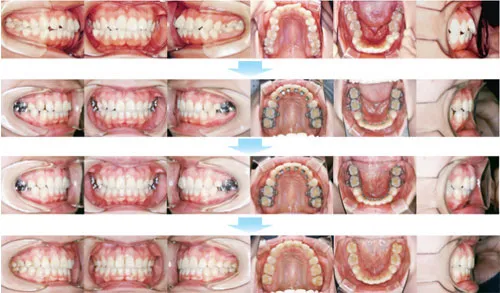 治療例（見えない矯正歯科治療（舌側矯正治療））07