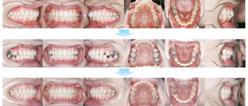 治療例（見えない矯正歯科治療（舌側矯正治療））08