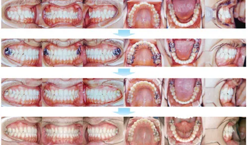 治療例（見えない矯正歯科治療（舌側矯正治療））09