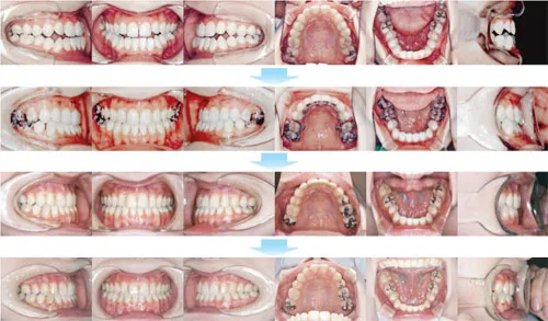 治療例（見えない矯正歯科治療（舌側矯正治療））10