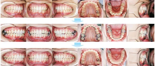 治療例（見えない矯正歯科治療（舌側矯正治療））11