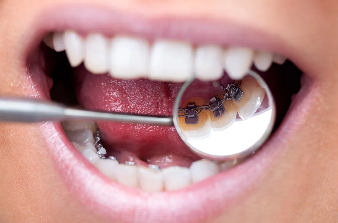 Feature 05 舌側矯正治療を実施できます。