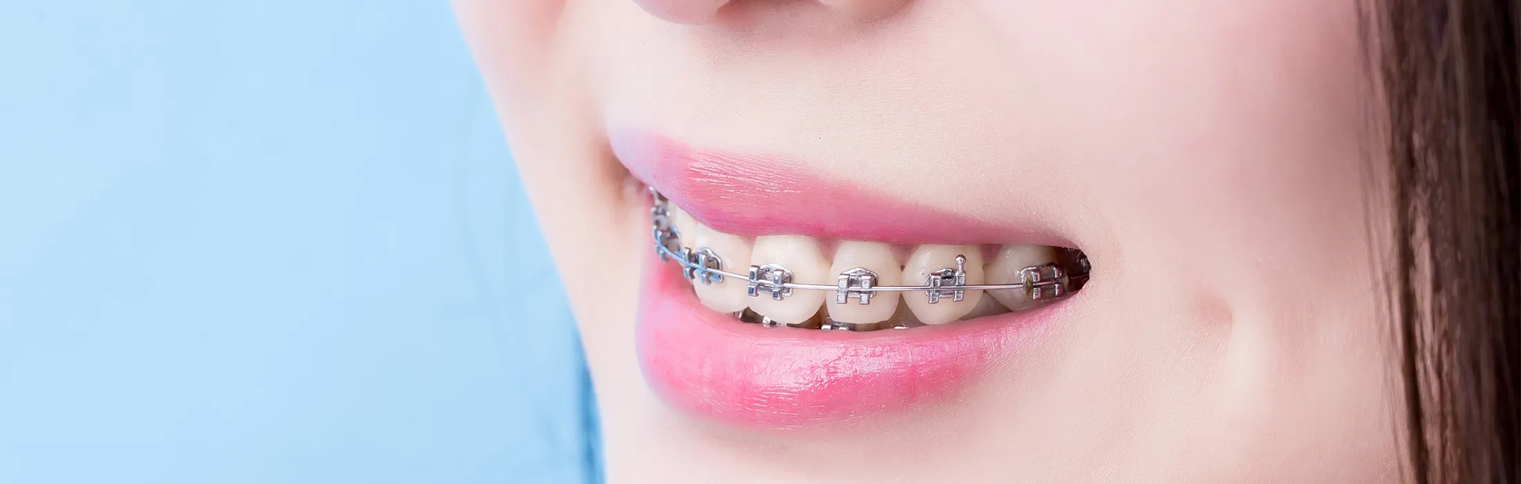 大人と10代の矯正装置