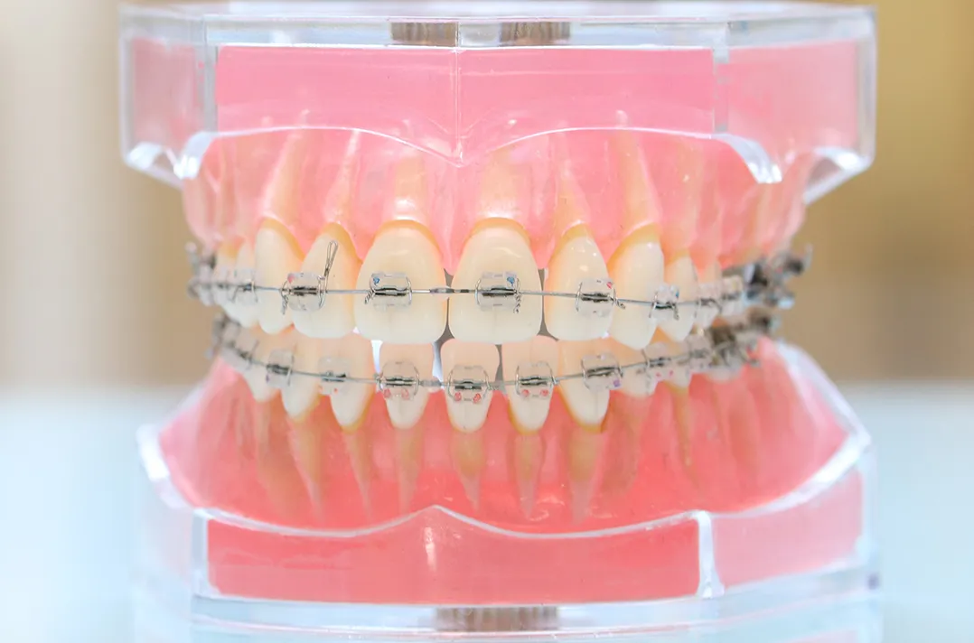 大人と成長終了後の10代の矯正治療に使用する装置「マルチブラケット装置」