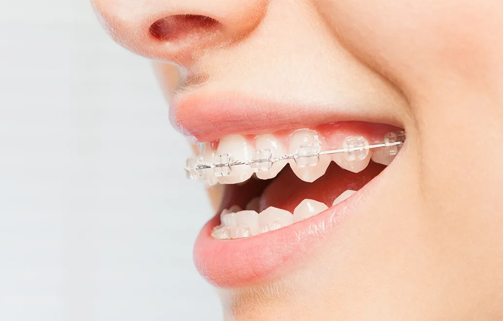 歯に付ける装置「ブラケット」