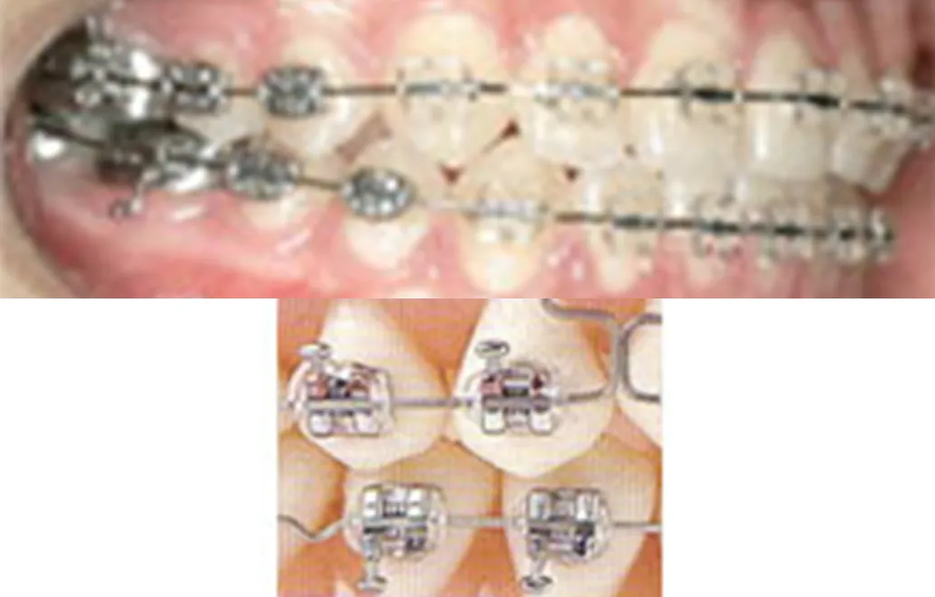 臼歯に装着する、ワイヤーを通す溝がある金属製の装置