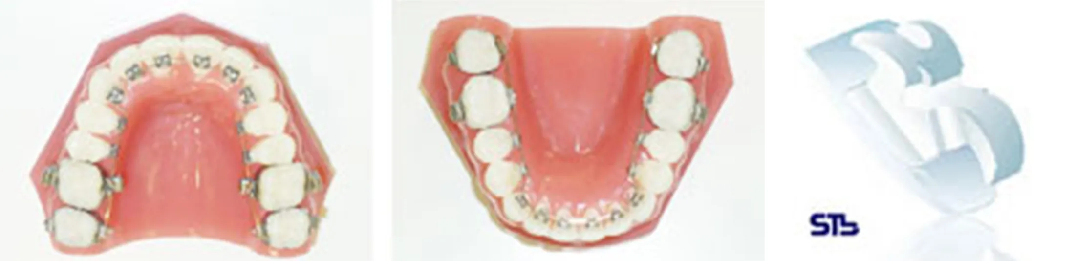 リンガルブラケット矯正装置(STb)
