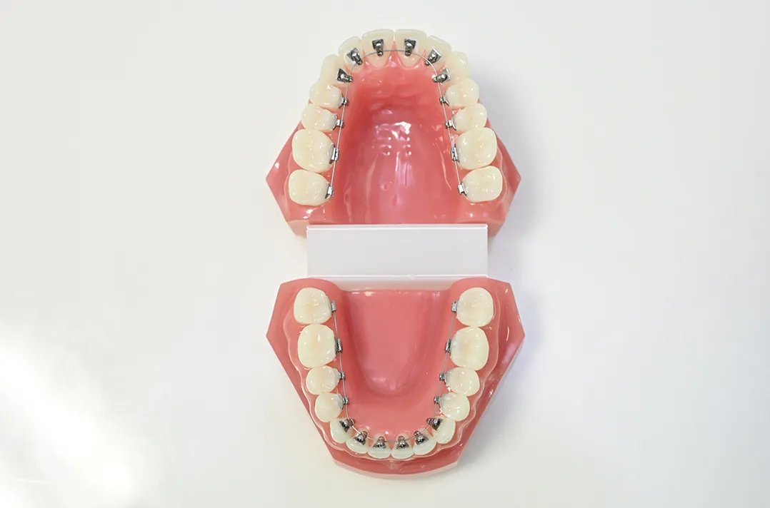 リンガルブラケット矯正装置(STb)とは?