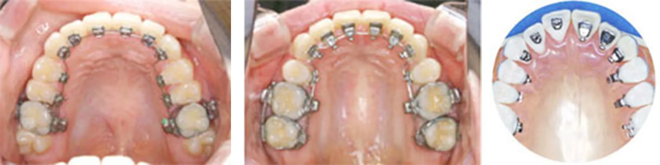 リンガルブラケット矯正装置(STb)(左)と旧タイプ(右)の比較