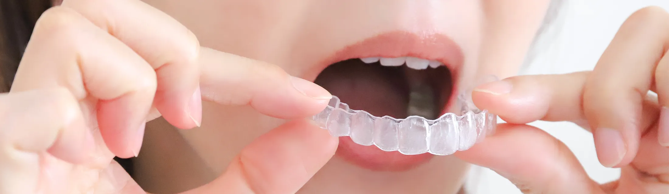 マウスピース型矯正装置を用いた治療