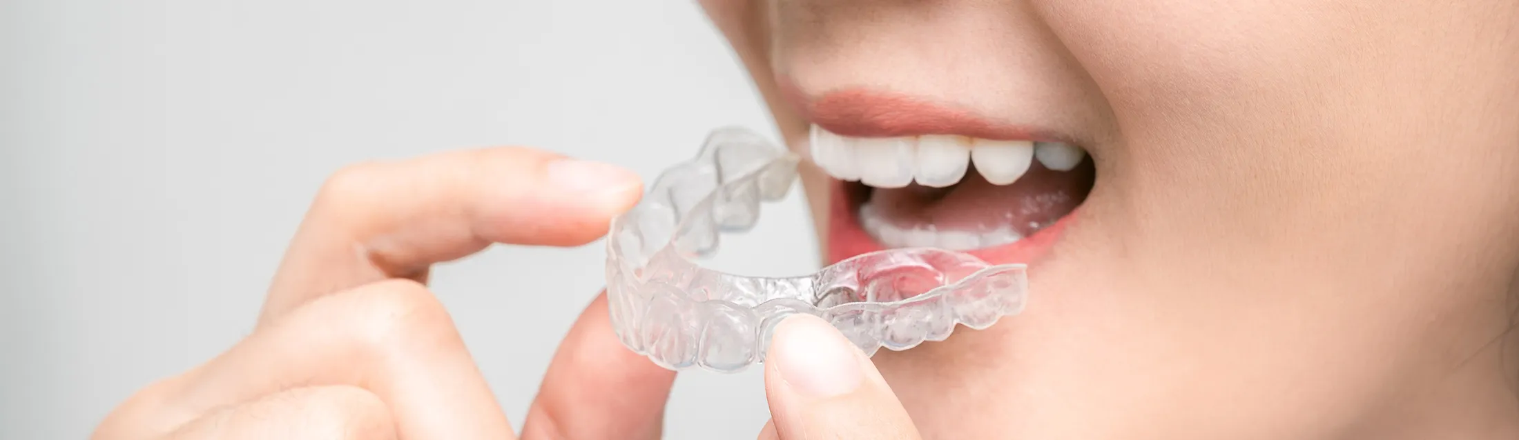 マウスピース型矯正装置（インビザライン）を用いた治療