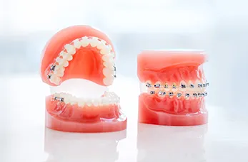 小児の早期治療・成長期の治療(1期治療):2〜3年 1期治療後の全体矯正(2期治療):2〜3年 全体矯正:2〜3年半 部分(限局)矯正:1〜2年