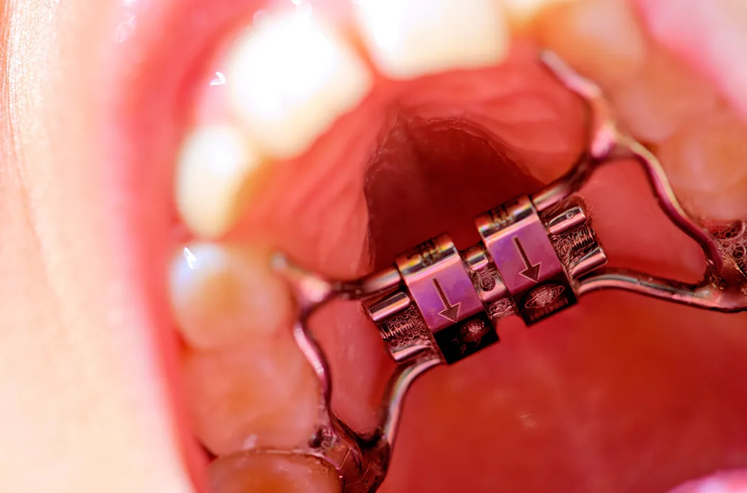 小児の早期治療・成長期の治療(1期治療)