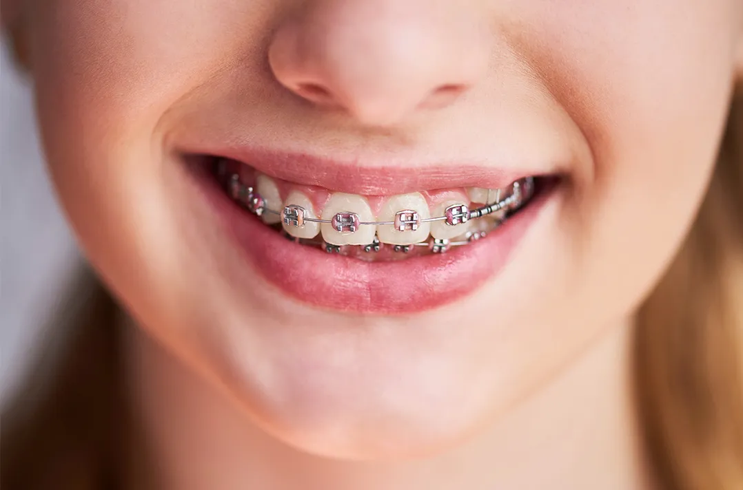 全体矯正・1期治療後の全体矯正(2期治療)