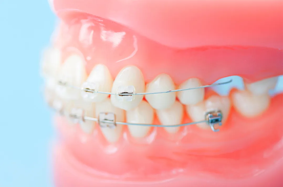 部分(限局)矯正治療