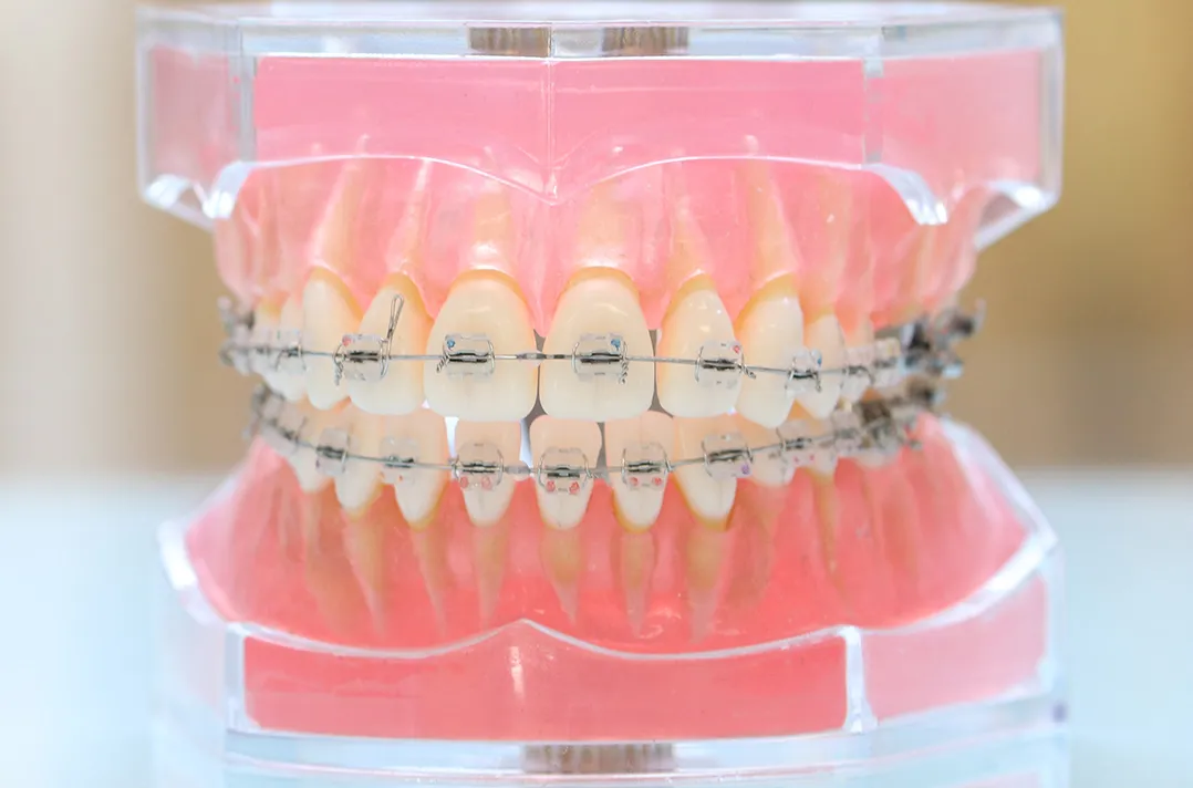 大人と成長終了後の10代の矯正治療に使用する装置「マルチブラケット装置」