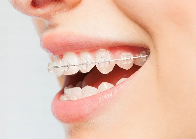 歯に付ける装置「ブラケット」