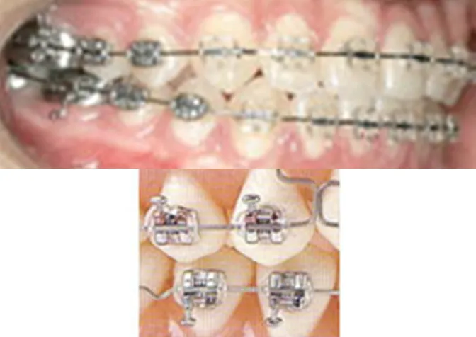 臼歯に装着する、ワイヤーを通す溝がある金属製の装置