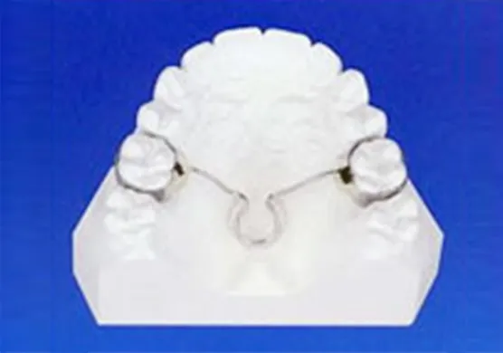 機械的矯正装置(パラタルバー)