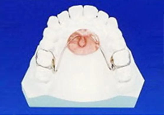 機械的矯正装置(ホールディングアーチ)