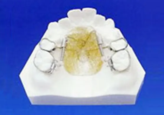 機械的矯正装置(ディスタルジェット)