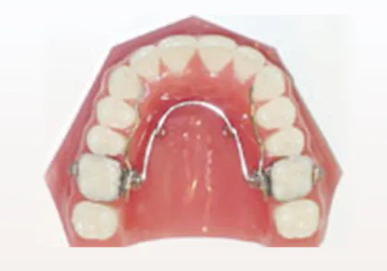 機械的矯正装置(ミア/クワッドヘリックス/Wアーチ)