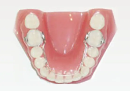 緩徐拡大装置(バイヘリックス/Wアーチ)