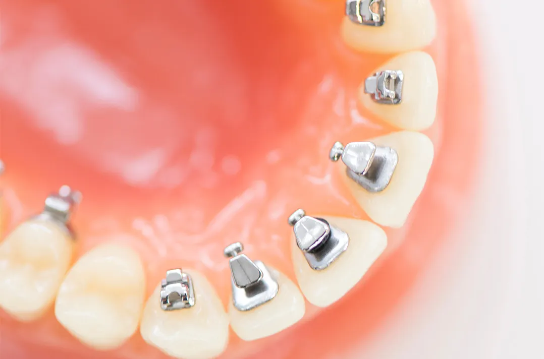 見えにくい舌側矯正装置