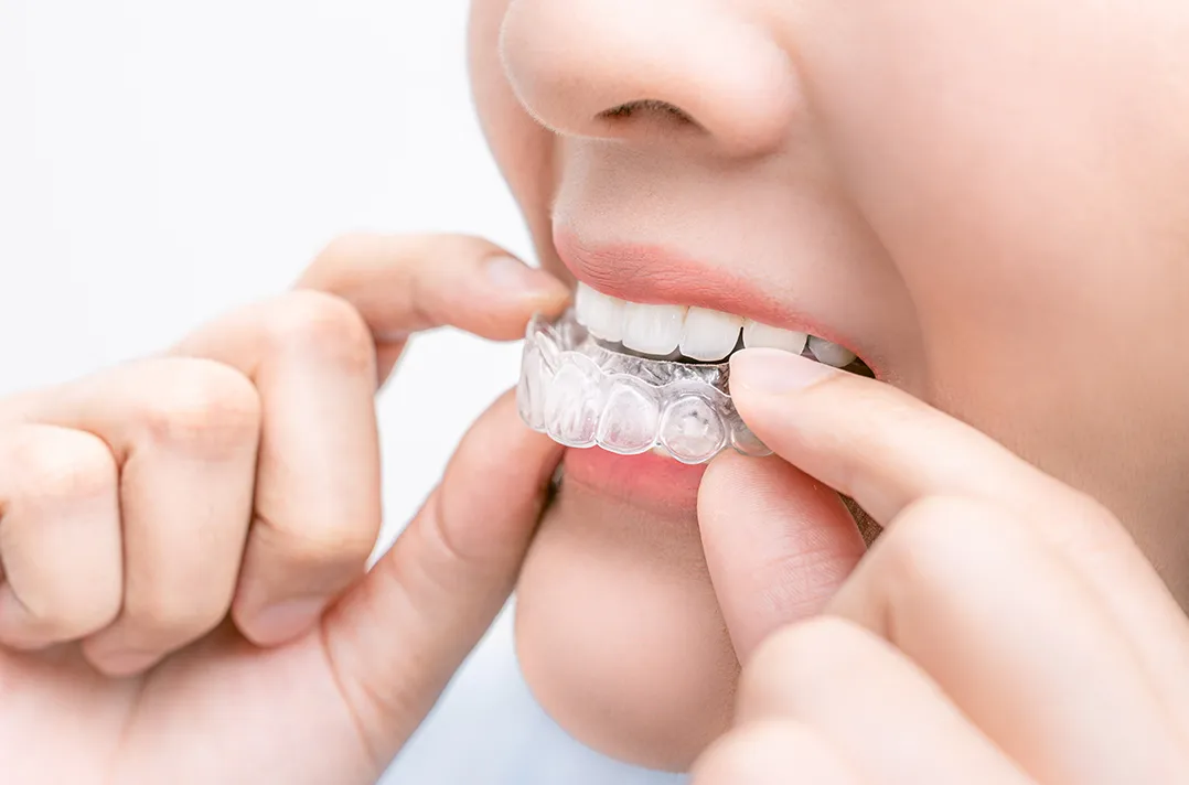 マウスピース型矯正装置