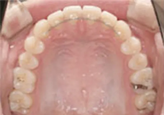 固定式保定装置(フィックスリテーナー)01