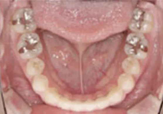 固定式保定装置(フィックスリテーナー)02