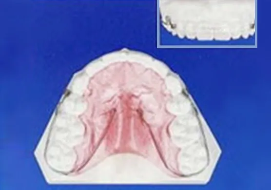 可撤式保定装置(QCM リテーナー)