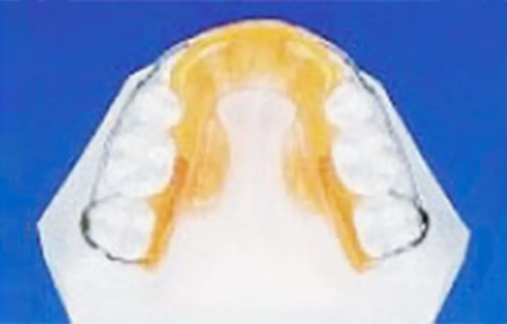 筋機能療法（MFT＝口腔周囲筋トレーニング）症例02