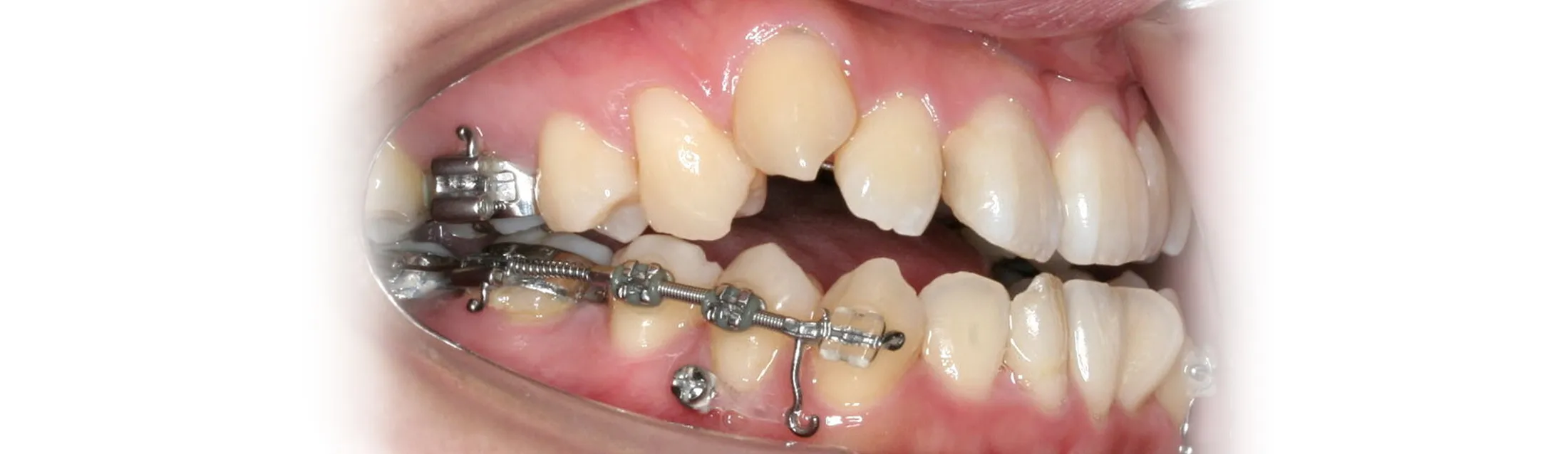 インプラント矯正歯科治療（歯科矯正用アンカースクリュー）を用いた治療