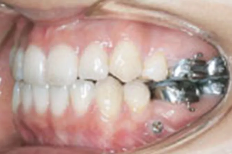 表面麻酔の後、局所麻酔を行ないます。