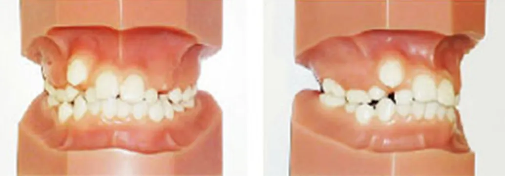 乱杭(らんぐい)歯(叢生)