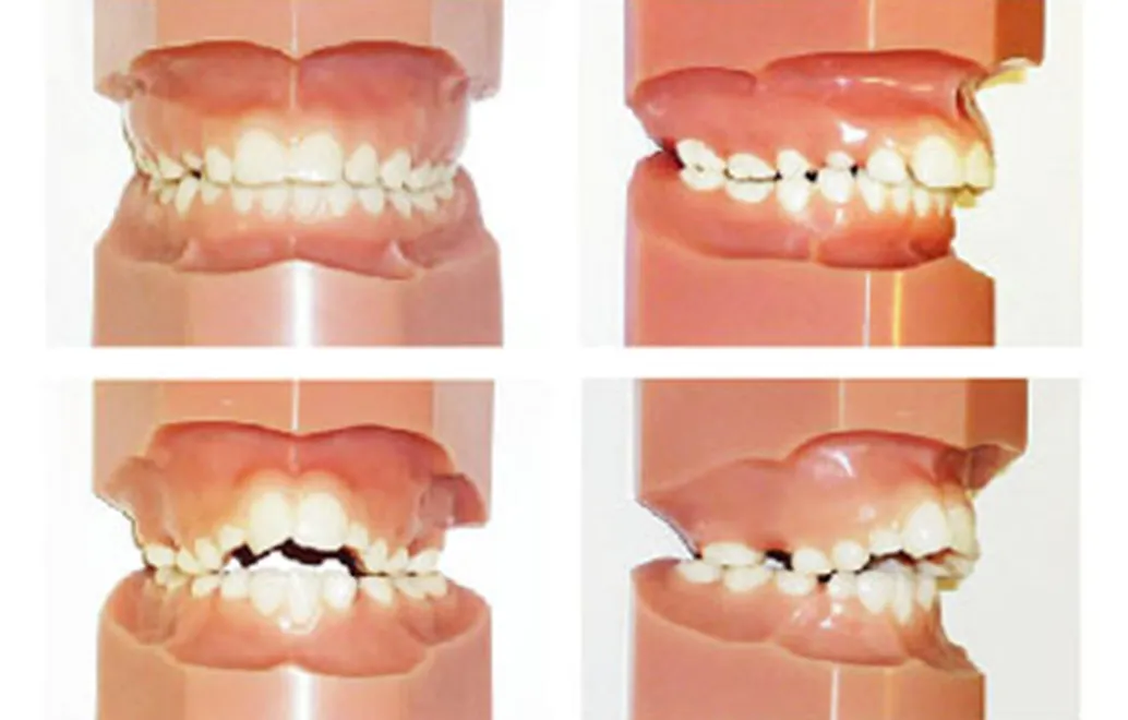 出っ歯(上顎前突)